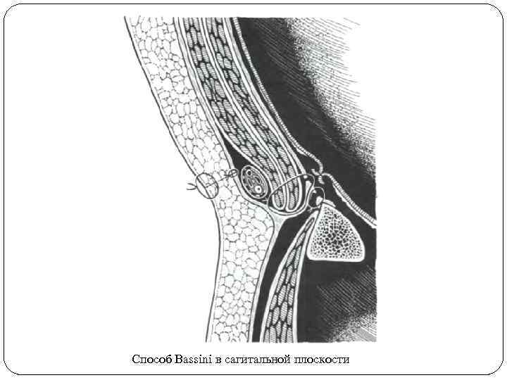 Способ Bassini в сагитальной плоскости 