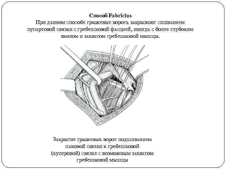 Способ Fabricius При данном способе грыжевые ворота закрывают сшиванием пупартовой связки с гребешковой фасцией,