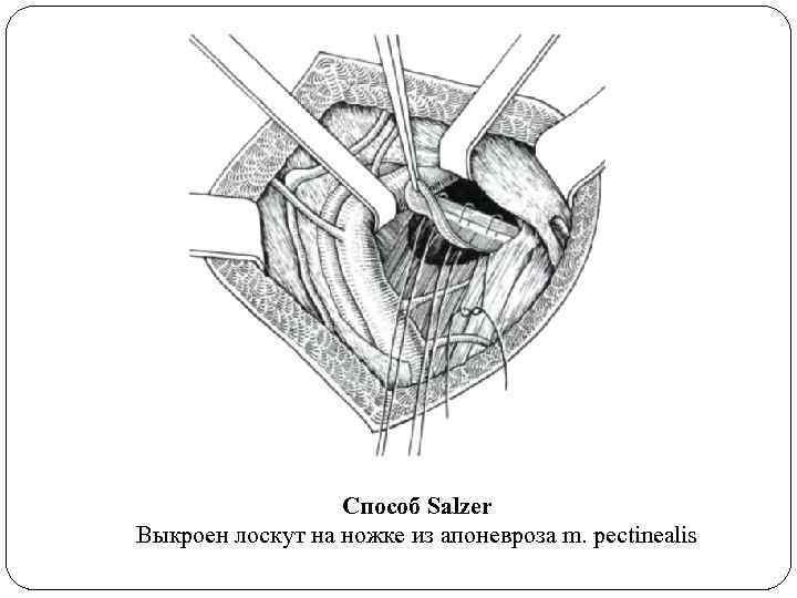 Способ Salzer Выкроен лоскут на ножке из апоневроза m. pectinealis 