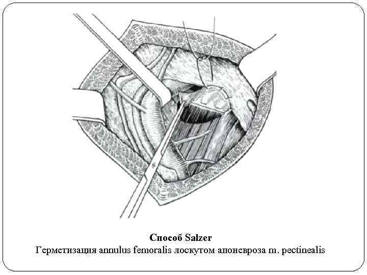 Способ Salzer Герметизация annulus femoralis лоскутом апоневроза m. pectinealis 