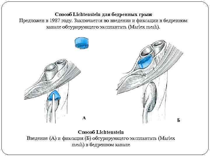 Способ Lichtenstein для бедренных грыж Предложен в 1987 году. Заключается во введении и фиксации