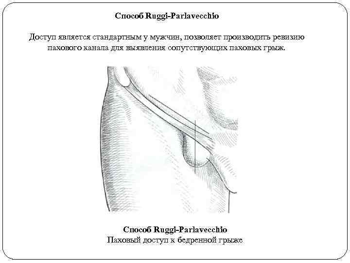 Способ Ruggi-Parlavecchio Доступ является стандартным у мужчин, позволяет производить ревизию пахового канала для выявления