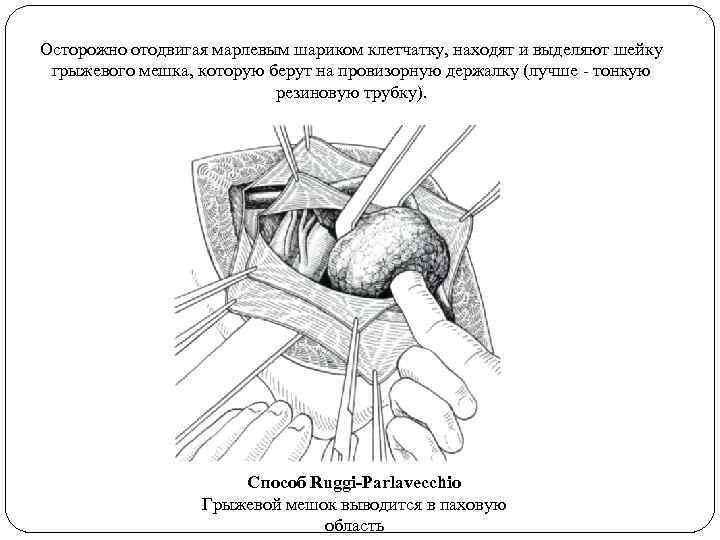 Осторожно отодвигая марлевым шариком клетчатку, находят и выделяют шейку грыжевого мешка, которую берут на