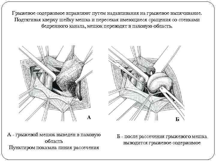 Грыжевое содержимое вправляют путем надавливания на грыжевое выпячивание. Подтягивая кверху шейку мешка и пересекая
