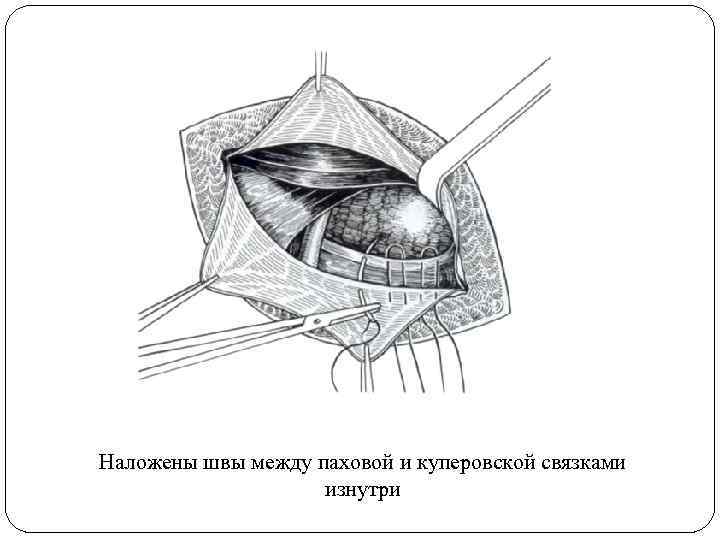 Наложены швы между паховой и куперовской связками изнутри 