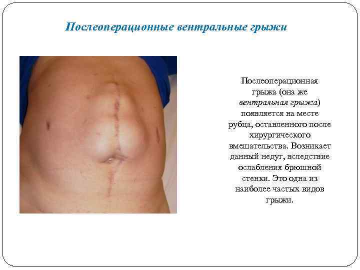 Послеоперационные вентральные грыжи Послеоперационная грыжа (она же вентральная грыжа) появляется на месте рубца, оставленного