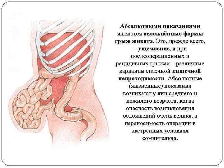 Абсолютными показаниями являются осложнённые формы грыж живота. Это, прежде всего, – ущемление, а при