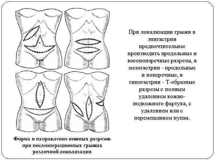 При локализации грыжи в эпигастрии предпочтительнее производить продольные и косопоперечные разрезы, в мезогастрии -