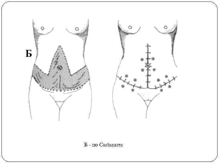 Б - по Castanares 
