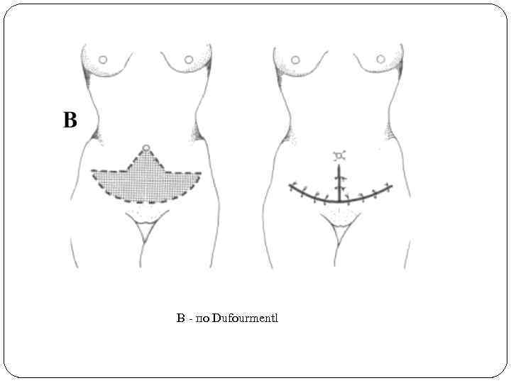 В - по Dufourmentl 