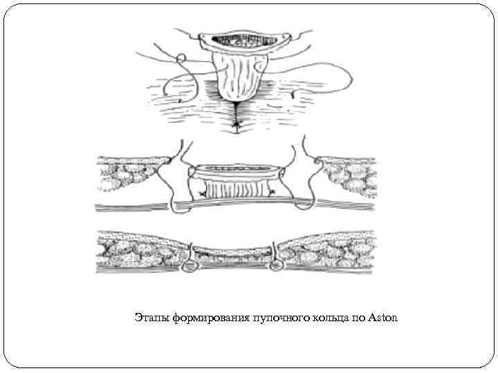 Этапы формирования пупочного кольца по Aston 