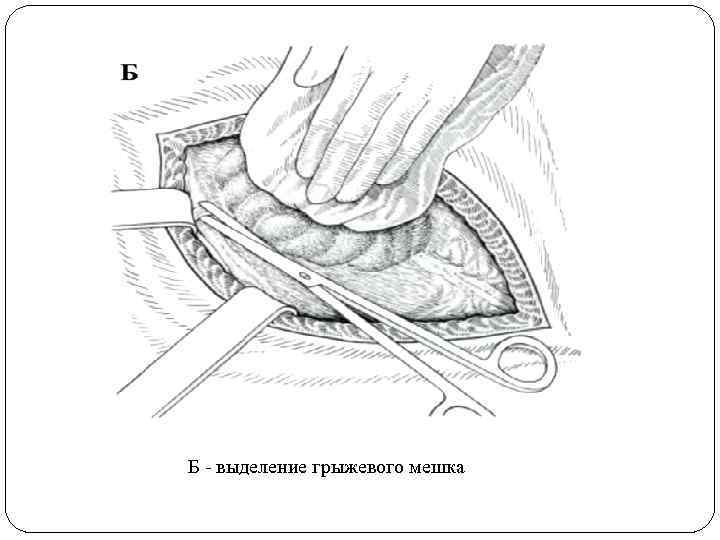 Б - выделение грыжевого мешка 