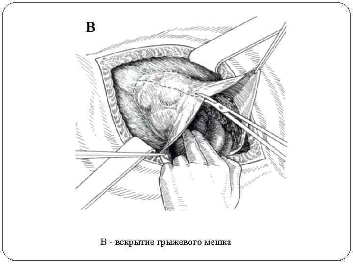 В - вскрытие грыжевого мешка 