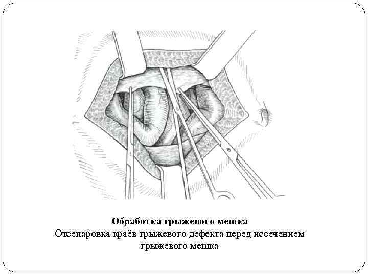 Обработка грыжевого мешка Отсепаровка краёв грыжевого дефекта перед иссечением грыжевого мешка 