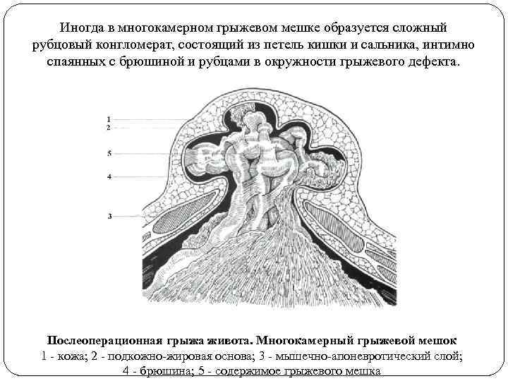 Иногда в многокамерном грыжевом мешке образуется сложный рубцовый конгломерат, состоящий из петель кишки и