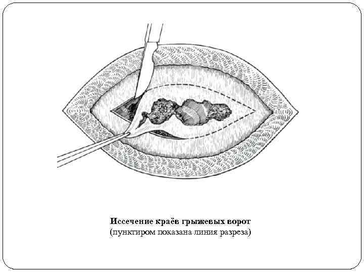 Иссечение краёв грыжевых ворот (пунктиром показана линия разреза) 