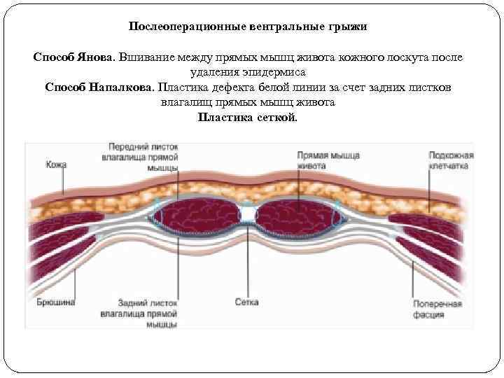 Ущемленная вентральная грыжа карта вызова