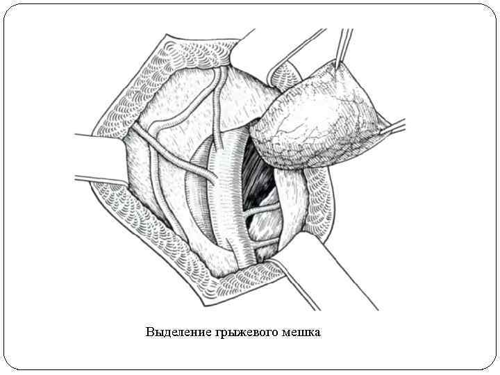 Выделение грыжевого мешка 