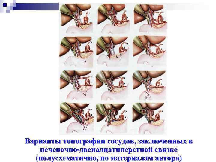 Варианты топографии сосудов, заключенных в печеночно-двенадцатиперстной связке (полусхематично, по материалам автора) 