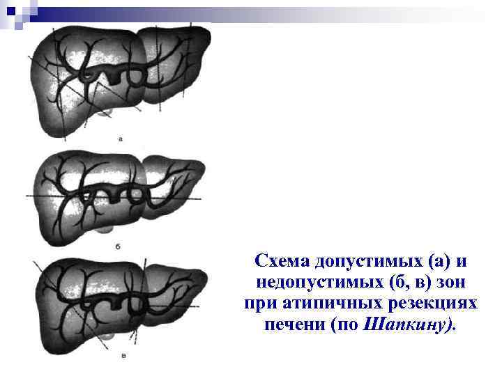 Схема допустимых (а) и недопустимых (б, в) зон при атипичных резекциях печени (по Шапкину).