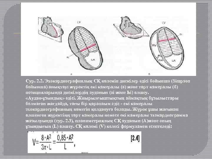 Сур. 2. 2. Эхокардиографиялық СҚ көлемін дискілер әдісі бойынша (Simpson бойынша) анықтау: жүректің екі