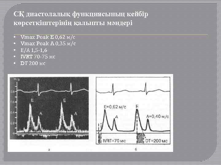 СҚ диастолалық функциясының кейбір көрсеткіштерінің қалыпты мәндері • • • Vmax Peak E 0,