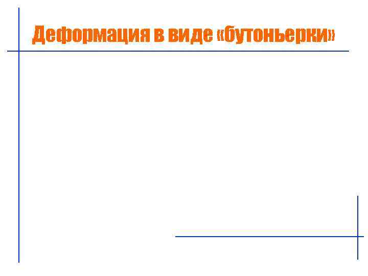 Деформация в виде «бутоньерки» 