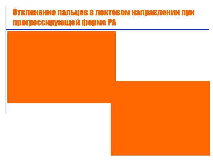 Отклонение пальцев в локтевом направлении прогрессирующей форме РА 