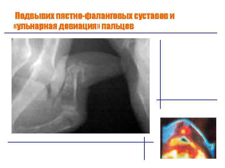 Подвывих пястно-фаланговых суставов и «ульнарная девиация» пальцев 