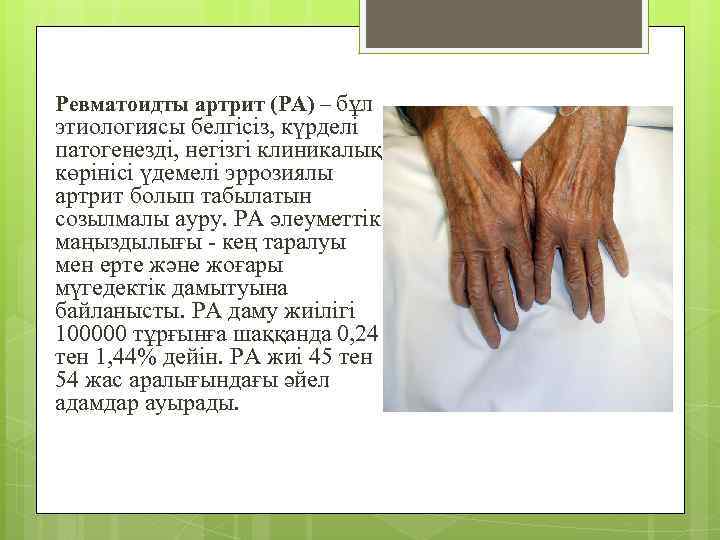 Ревматоидты артрит (РА) – бұл этиологиясы белгісіз, күрделі патогенезді, негізгі клиникалық көрінісі үдемелі эррозиялы
