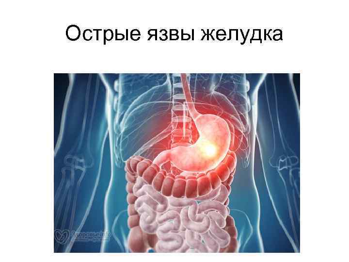 Острые язвы желудка 