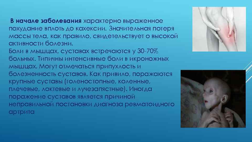 В начале заболевания характерно выраженное похудание вплоть до кахексии. Значительная потеря массы тела, как