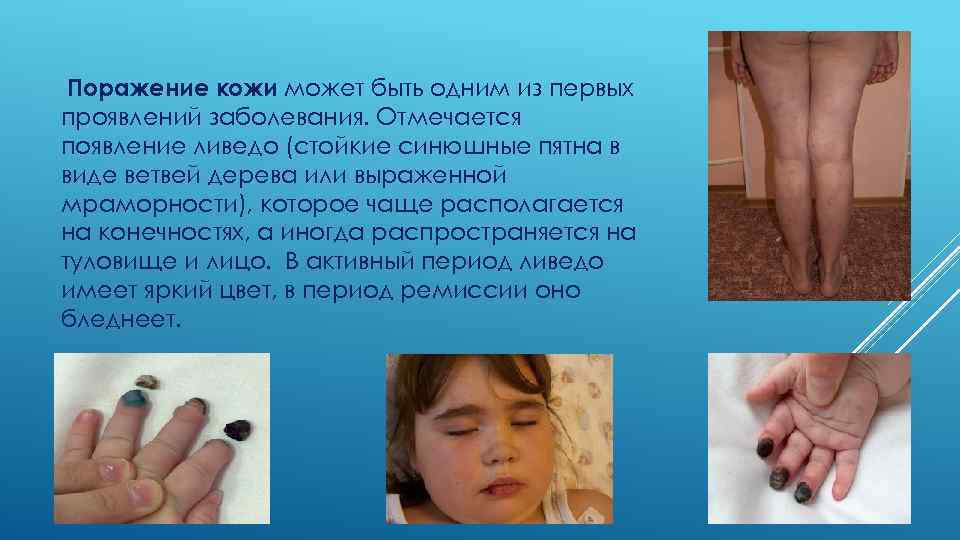  Поражение кожи может быть одним из первых проявлений заболевания. Отмечается появление ливедо (стойкие
