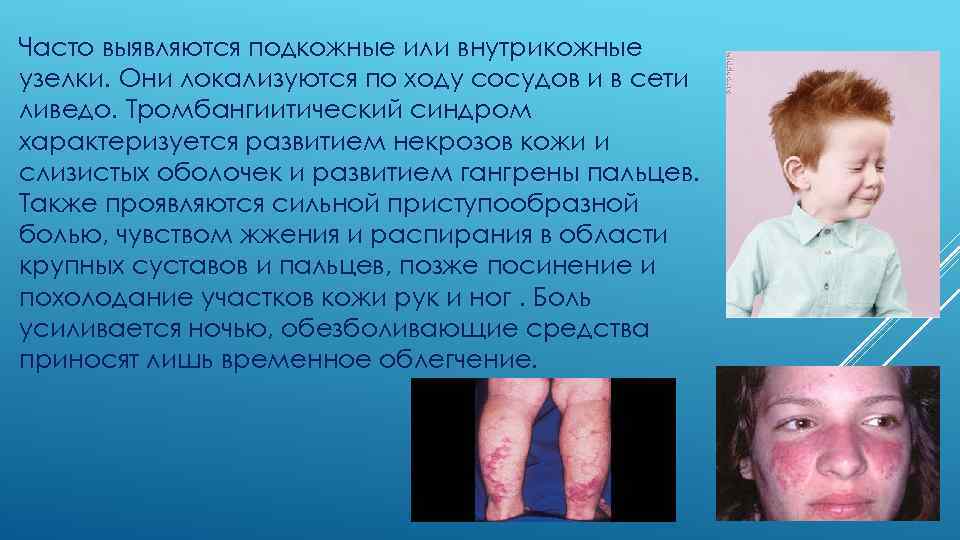 Часто выявляются подкожные или внутрикожные узелки. Они локализуются по ходу сосудов и в сети