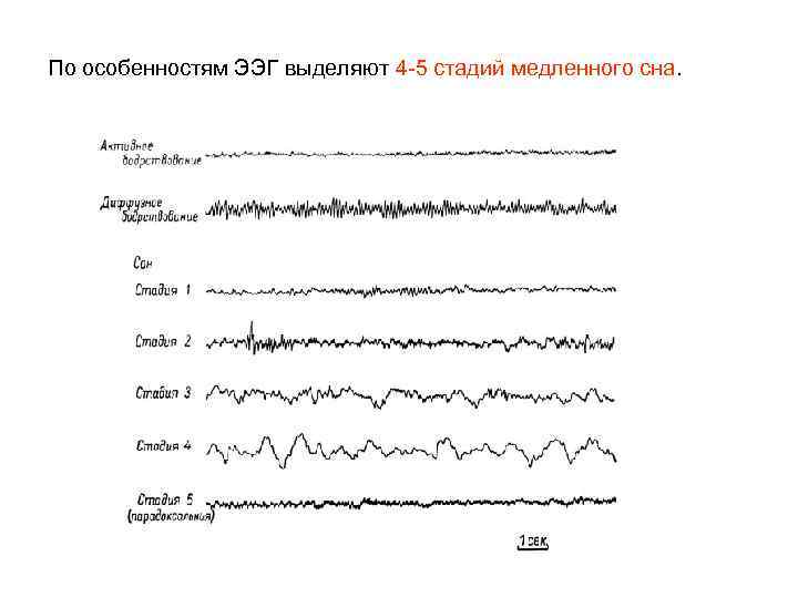 По особенностям ЭЭГ выделяют 4 -5 стадий медленного сна. 