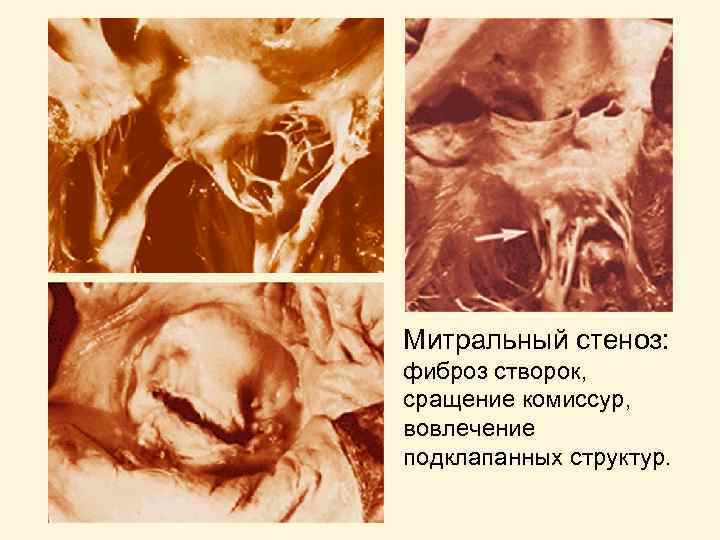 Митральный стеноз: фиброз створок, сращение комиссур, вовлечение подклапанных структур. 