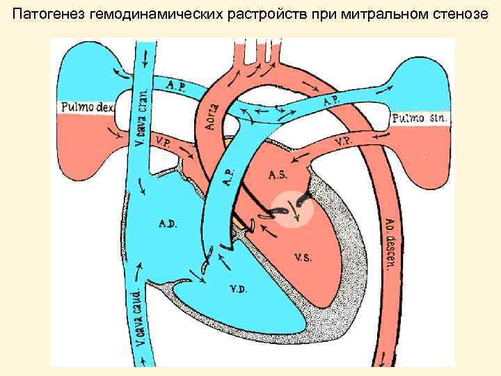 Патогенез гемодинамических растройств при митральном стенозе 