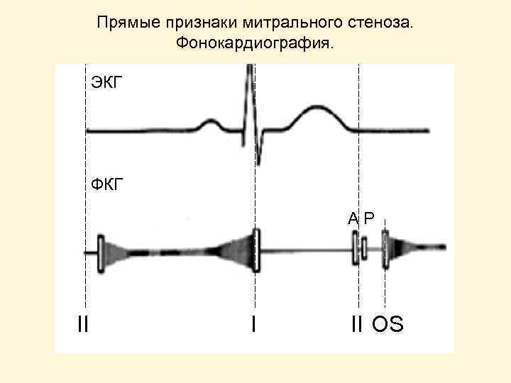 Экг при пролапсе митрального клапана фото