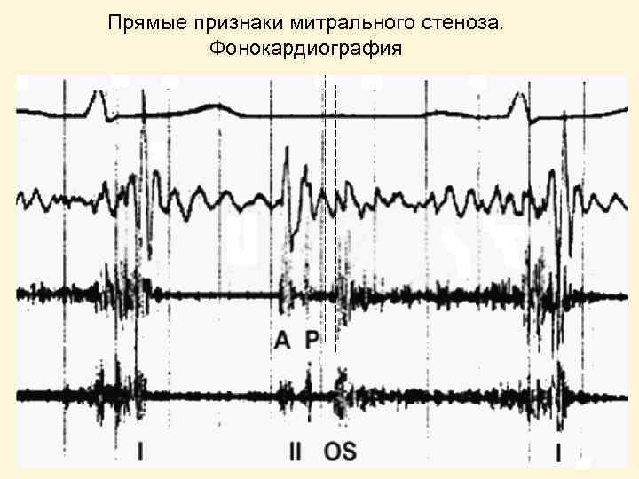 Прямые признаки митрального стеноза. Фонокардиография 