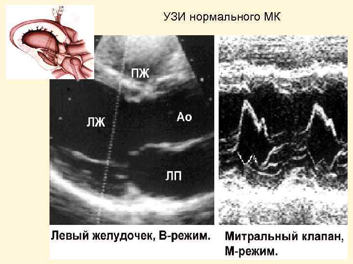 УЗИ нормального МК 