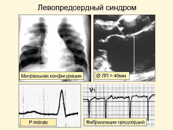 Левопредсердный синдром ЛП > 40 мм Митральная конфигурация V 1 P mitrale Фибрилляция предсердий