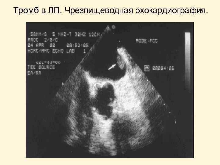 Тромб в ЛП. Чрезпищеводная эхокардиография. 