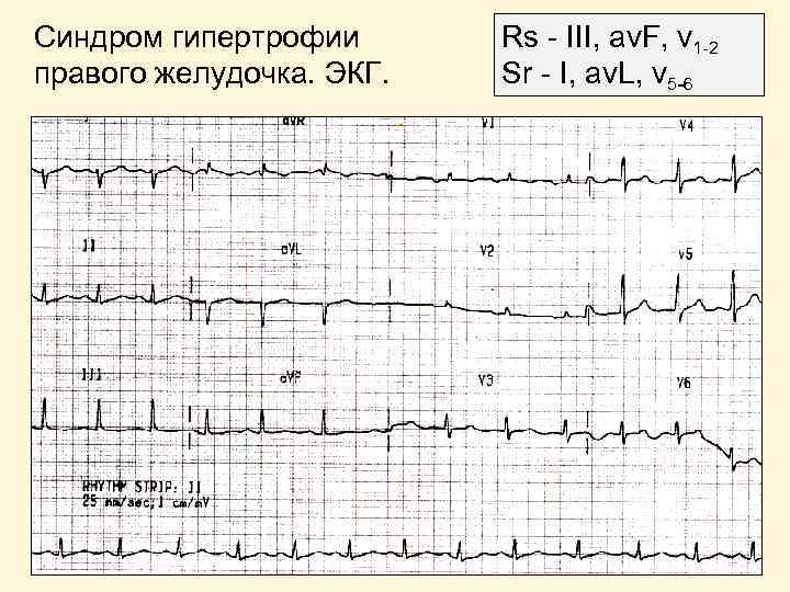 Синдром гипертрофии правого желудочка. ЭКГ. Rs - III, av. F, v 1 -2 Sr