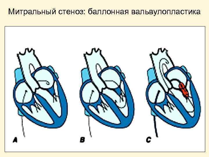 Стеноз митрального клапана презентация - 88 фото