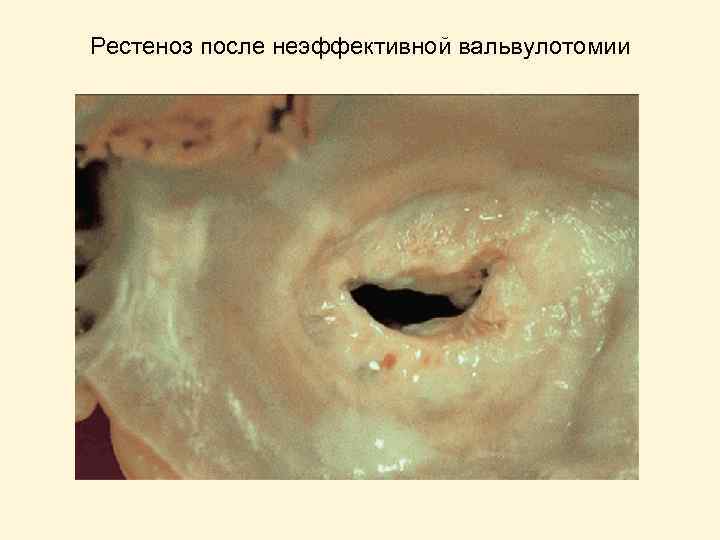 Рестеноз после неэффективной вальвулотомии 