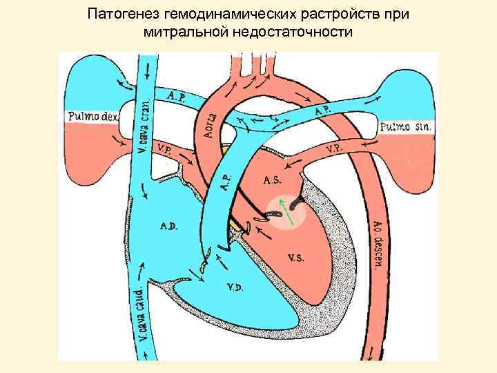 Патогенез гемодинамических растройств при митральной недостаточности 