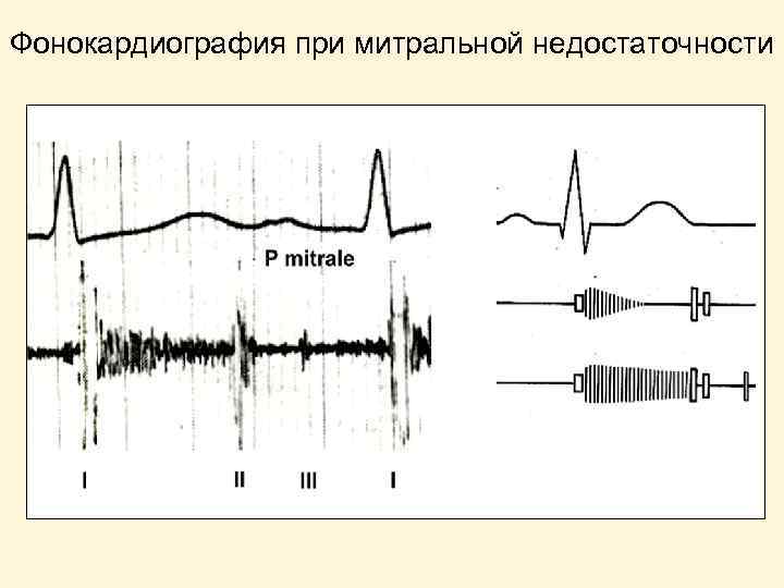 Фонокардиография при митральной недостаточности 