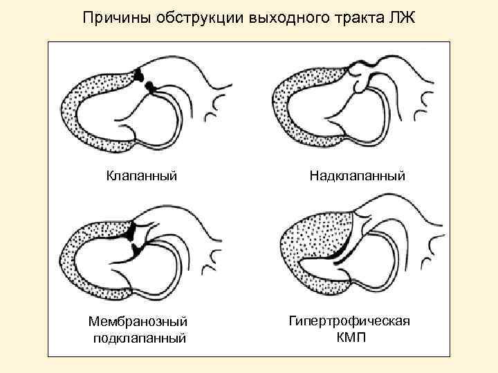 Причины обструкции выходного тракта ЛЖ Клапанный Мембранозный подклапанный Надклапанный Гипертрофическая КМП 