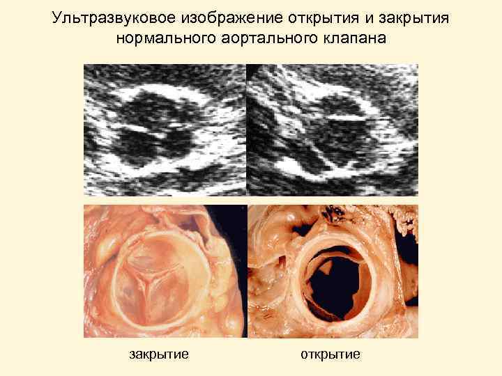 Ультразвуковое изображение открытия и закрытия нормального аортального клапана закрытие открытие 