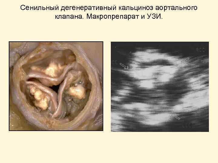 Сенильный дегенеративный кальциноз аортального клапана. Макропрепарат и УЗИ. 